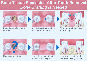 Dentist Glendale: Bone Grafting Types, How and Why Is It Done - Smile  Makeover of LA
